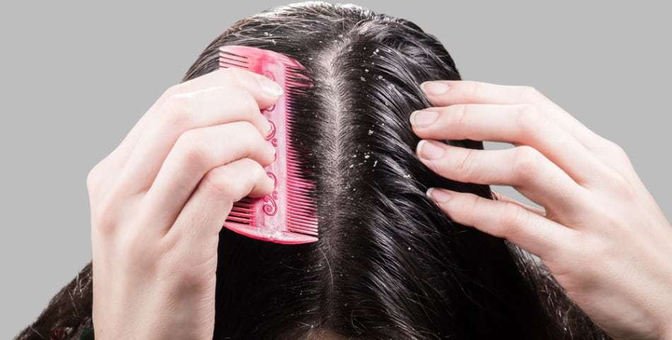 علاج قشرة الشعر | علاج قشرة الشعر نهائياً | علاج قشرة الشعر بالخل | علاج قشرة الشعر بسرعة